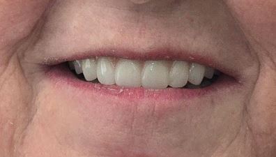 All-on-4 dental implant after treatment at Elm Ridge Implant and Family Dentistry in Killeen, TX